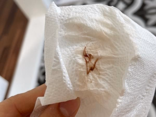 Was bedeuten braune Schmierblutungen vor der Periode?